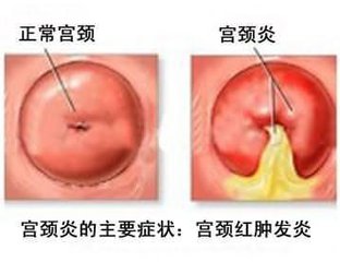 中度宫颈炎